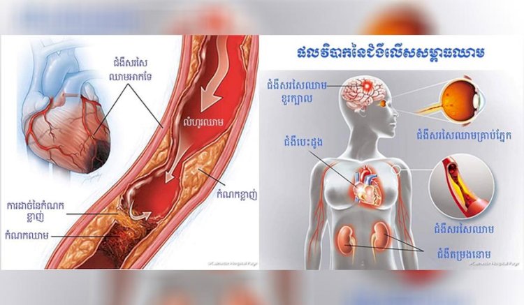 [វីដេអូ] Ep.61 ប្រធានបទ៖​ ផលវិបាករុំារ៉ៃនៃជំងឺទឹកនោមផ្អែម