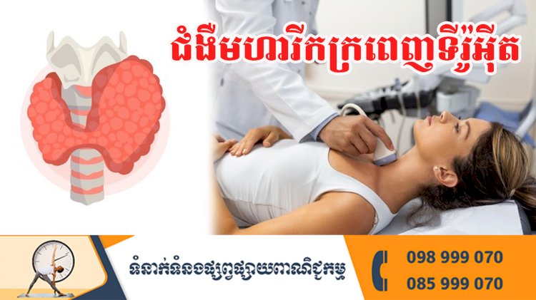 ប្រធានបទ ៖ ជំងឺមហារីកក្រពេញទីរ៉ូអុីត