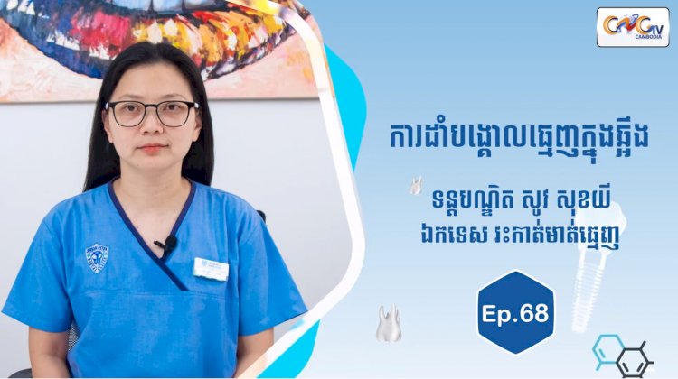 [វីដេអូ] Ep.68 ប្រធានបទ៖ ការដាំបង្គោលធ្មេញក្នុងឆ្អឹង